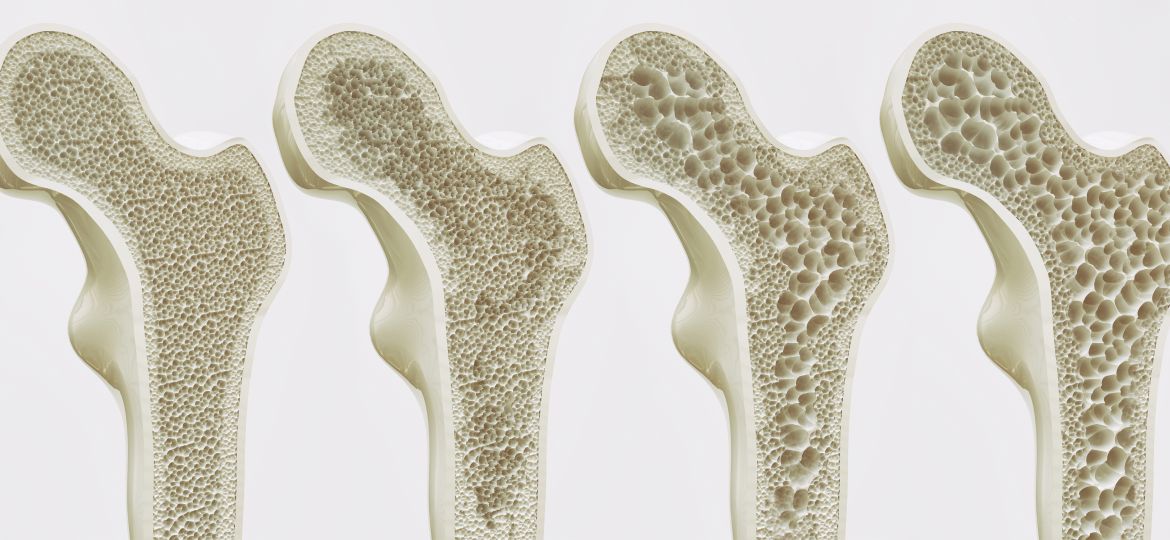 Apotheke Wassertrüdingen, Osteoporose